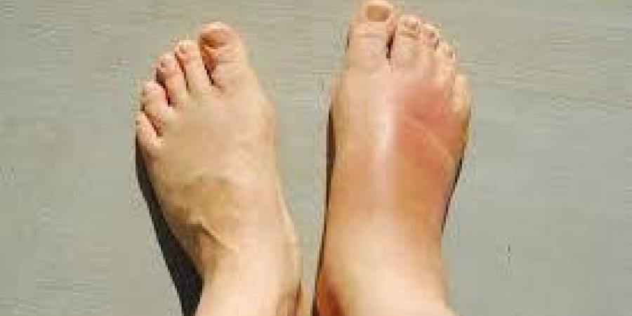 مشروبات طبيعية تساعد على طرد الأملاح وحصوات الكلى - هرم مصر