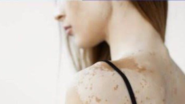 من هم الأكثر عرضة للإصابة بالبهاق؟