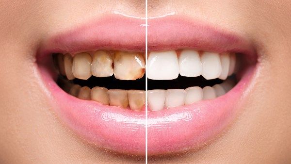 اصفرار الأسنان .. ما أسبابه وما حلوله ؟
