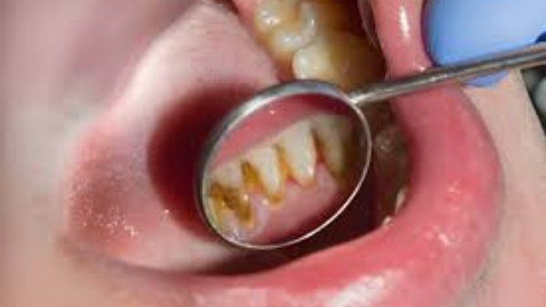 اصفرار الأسنان .. ما أسبابه وما حلوله ؟