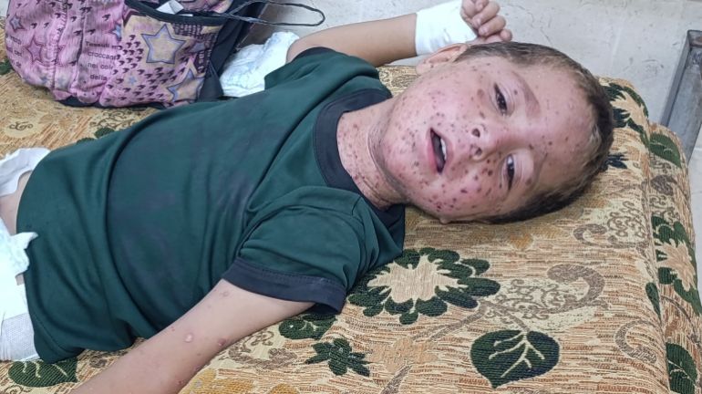 طفل فلسطيني مريض، وقد غطّت البقع والطفح الجلدي وجهه وجسده، وسط ظروف صحية وإنسانية بالغة السوء ونقص حاد في الرعاية الطبية والدواء