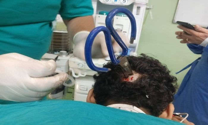 استخراج مقص من جمجمة مريض بمستشفى التأمين الصحي ببنها