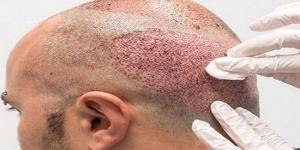 كيفية اختيار أفضل دكتور لزراعة الشعر في مصر