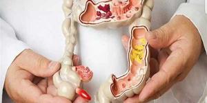 دراسة تكشف العلاقة بين التهاب الأمعاء وخطر الإصابة بالسرطان