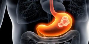 أعراض خفية تنذر بسرطانات الجهاز الهضمي قبل فوات الأوان.. تعرف عليها - جريدة هرم مصر