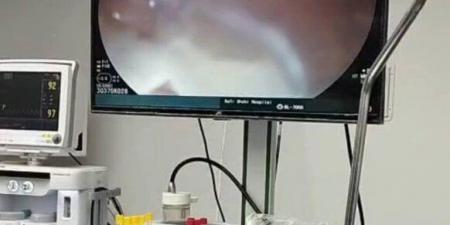 فريق طبي بمستشفي كفر شكر ينجح في إنقاذ حياة مسن إثر انسداد المرئ - هرم مصر