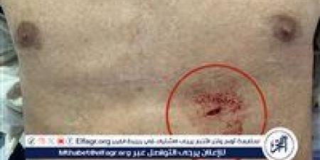 فريق طبي بمستشفى المنصورة الدولي ينقذ شابًا من موت محقق بعد طعنة مباشرة في القلب - هرم مصر