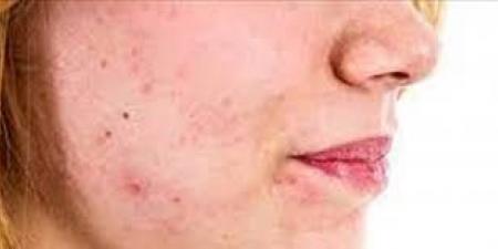 تظهر على الوجه.. 5 علامات تحذيرية لارتفاع الكوليسترول - هرم مصر