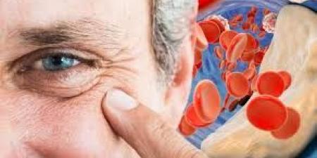 فقر الدم يسرق طاقتك بصمت… أعراض وأسباب وعلاج الأنيميا - هرم مصر