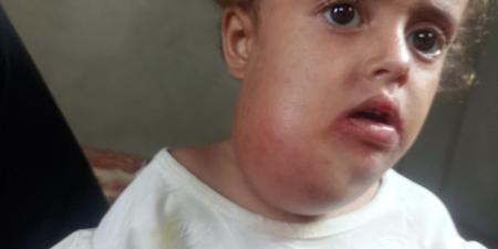 ورم في رقبتها وصعوبة بالنطق.. عجز المنظومة الصحية بغزة يهدد حياة الطفلة جوليا - هرم مصر