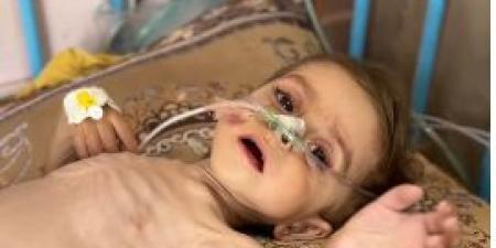 كريم معمر.. سوء التغذية يتسبب في تضخم بالكبد ولا أدوية بمستشفيات غزة - هرم مصر