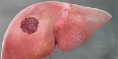 إنجاز طبي واعد ضد السرطان.. اكتشاف جديد يوقف نمو أورام الأمعاء والكبد - جريدة هرم مصر