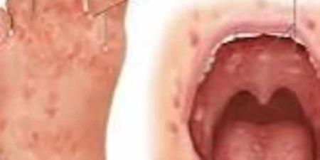 حدث في عاصمة بيرو.. تعليق الدراسة بسبب انتشار فيروس كوكساكى - جريدة هرم مصر