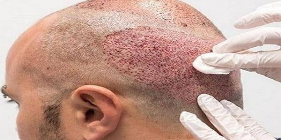 كيفية اختيار أفضل دكتور لزراعة الشعر في مصر