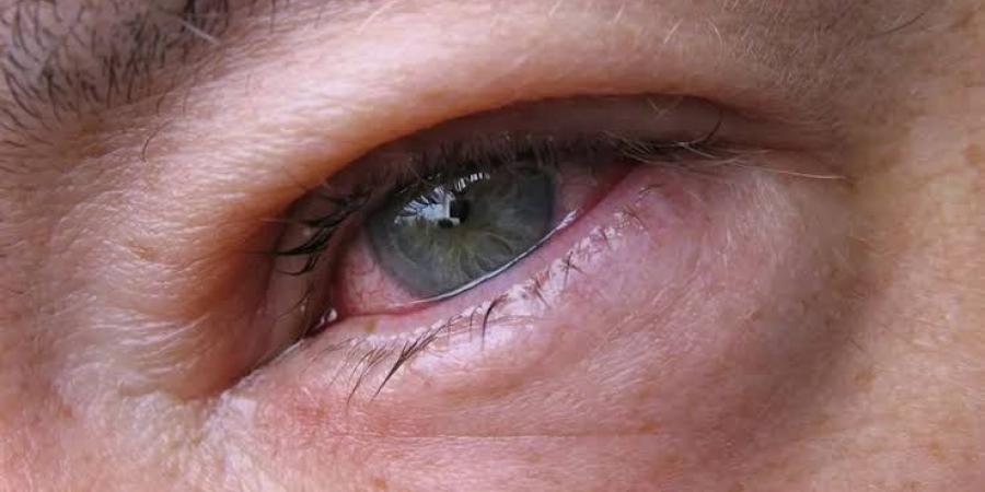 التهابات العيون في الصيف .. الأسباب وطرق الوقاية والعلاج - هرم مصر
