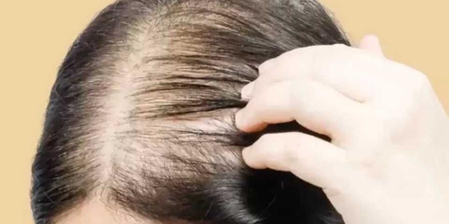 حلول حديثة لمعالجة الصلع الوراثي.. ما هي - هرم مصر