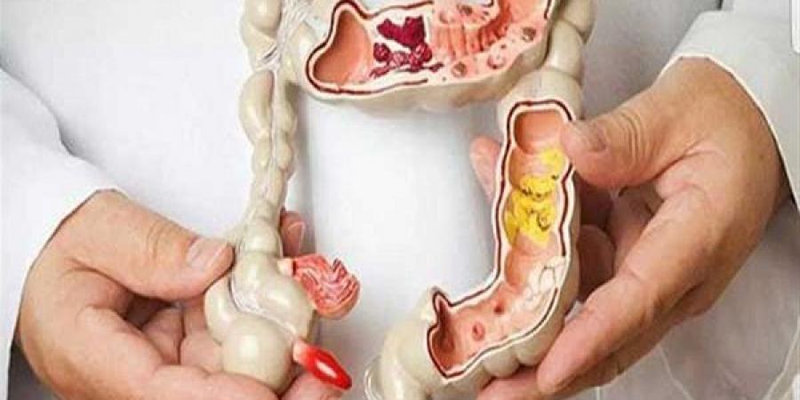 دراسة عقار يخفض خطر عودة سرطان القولون والوفاة بنسبة 50 #الصحة #منوعات #اخبار_الصحة #اخبار_منوعة #لايف_ستايل - هرم مصر