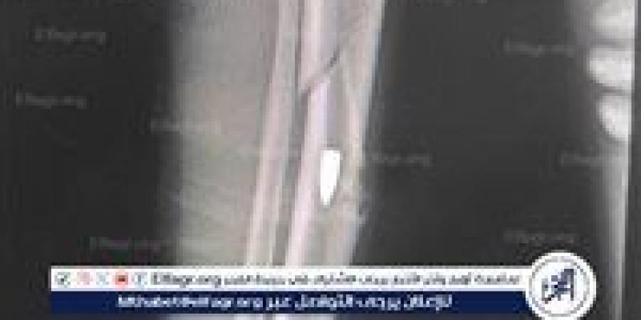 أصيب بطلق نارى يوم العيد..مستشفى قنا العام ينقذ شابًا من مضاعفات خطيرة بالساق - هرم مصر