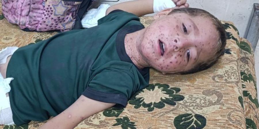 الطفح الجلدي ينهش أجساد الغزيين وصيدليات خاوية من كل دواء - هرم مصر