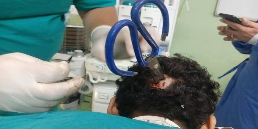 استخراج مقص من جمجمة مريض بمستشفى التأمين الصحي ببنها - هرم مصر