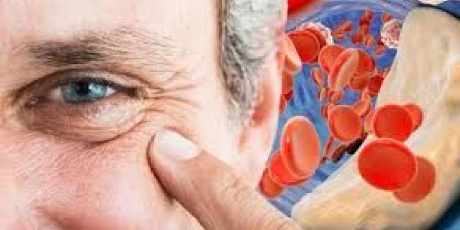 فقر الدم يسرق طاقتك بصمت… أعراض وأسباب وعلاج الأنيميا - هرم مصر