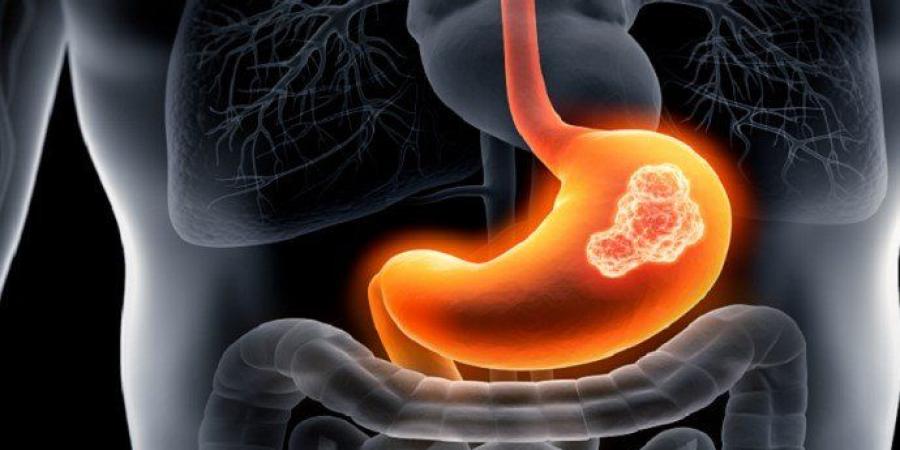 أعراض خفية تنذر بسرطانات الجهاز الهضمي قبل فوات الأوان.. تعرف عليها - جريدة هرم مصر